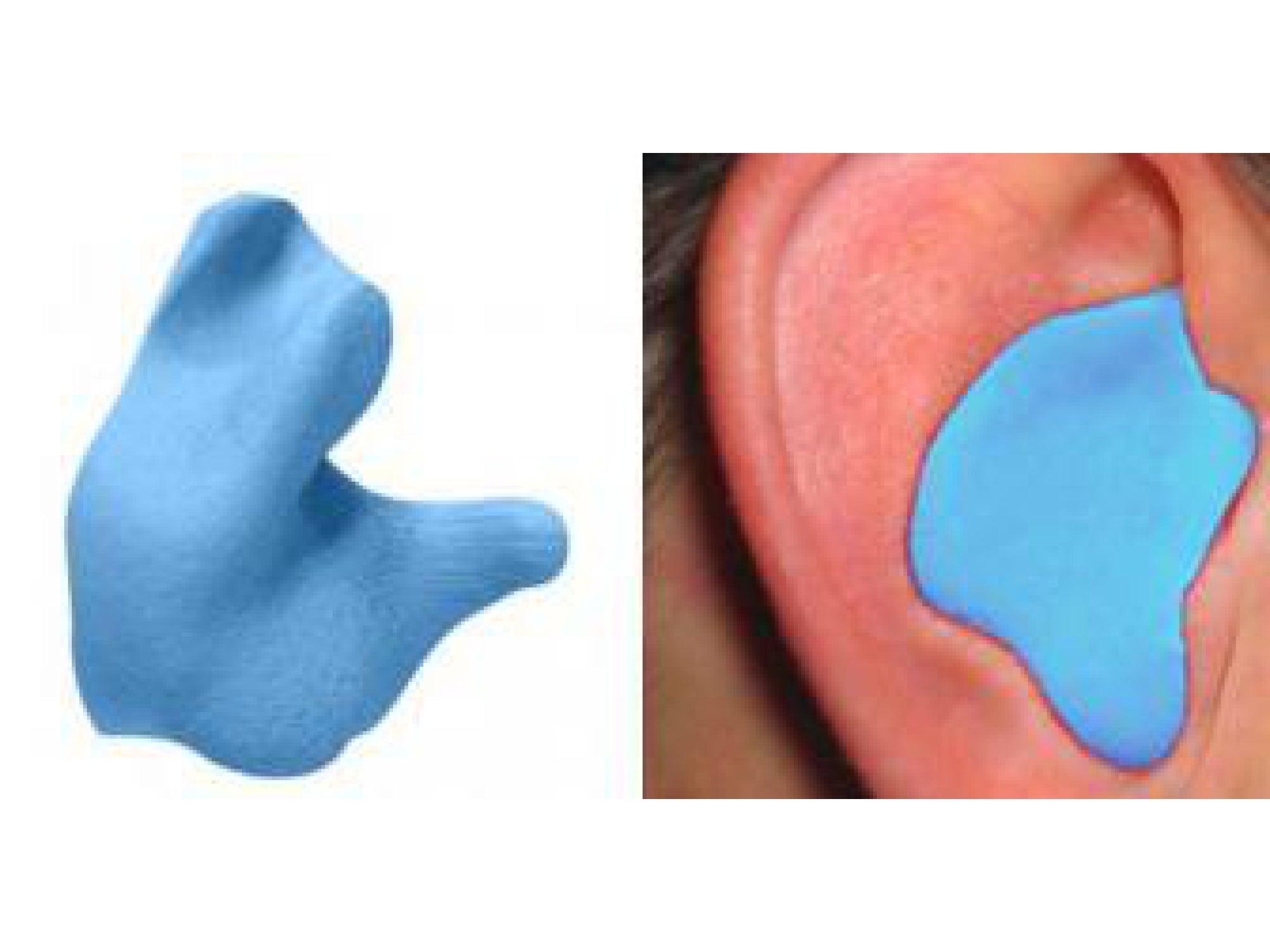 Radians Custom Molded Earplugs Blue | DIY Silicone Fit Kit